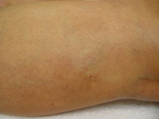 6 Weeks After 1 Treatment