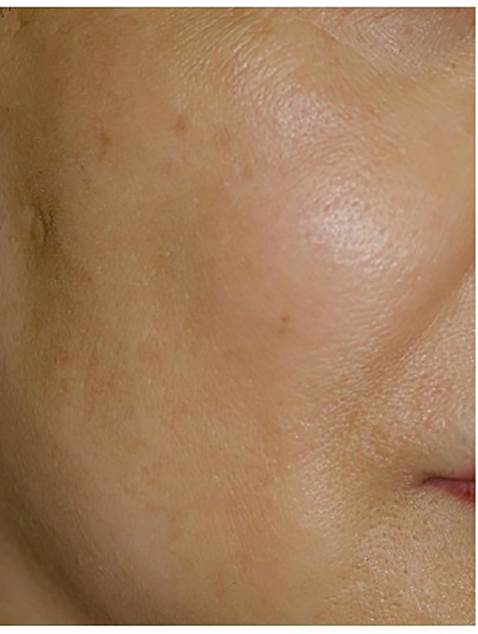 Pigment after laser treatment