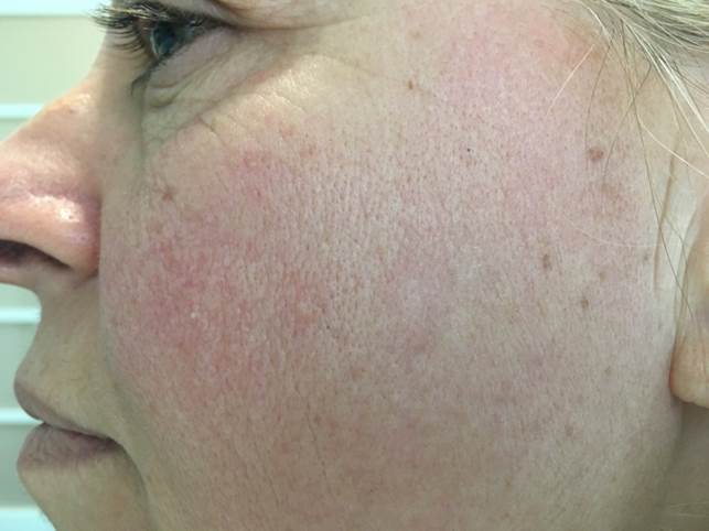 Pigment after laser treatment