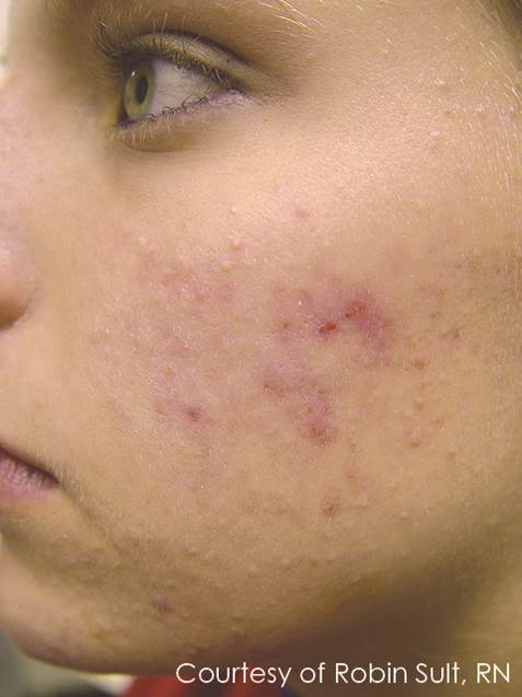 Before laser acne treatment