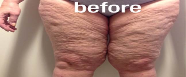 Skin tightening legs before