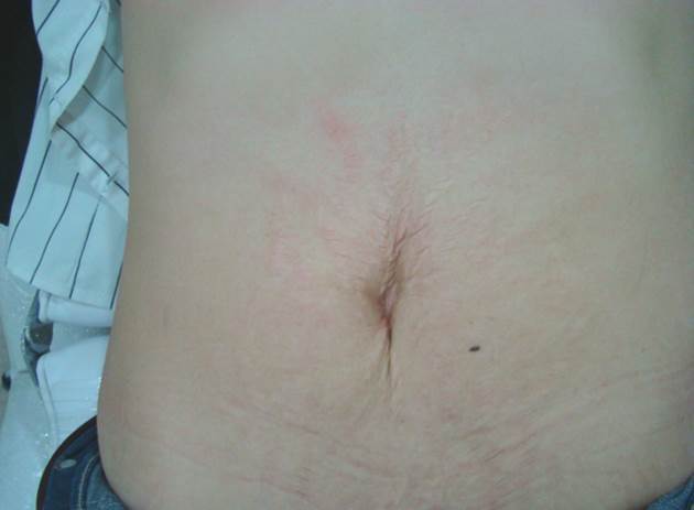 Skin tightening stomach after 3 sessions